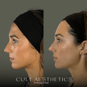 Brunette woman before and after from getting VI Peel