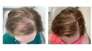 PRP PRF Before and after