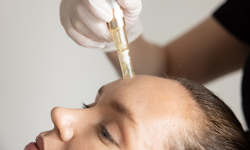 woman getting microneedling