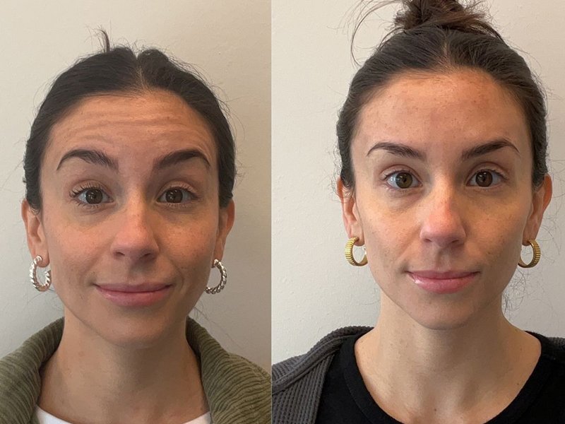Before and after photo - Anti Wrinkle