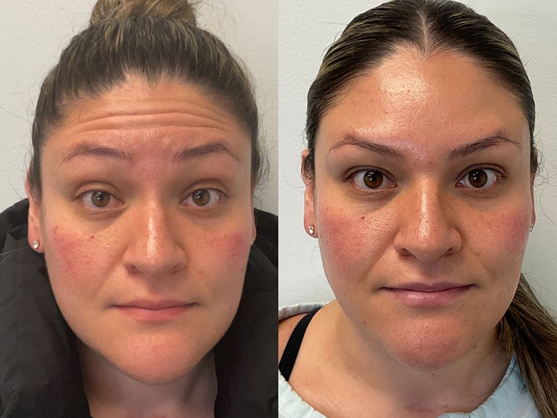Before and after photo - Anti wrinkle