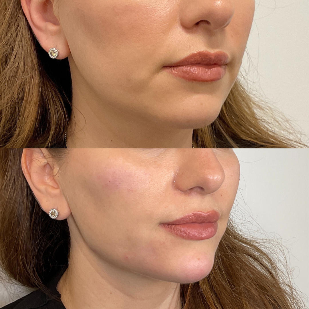 Cult Aesthetics Before and After Lips