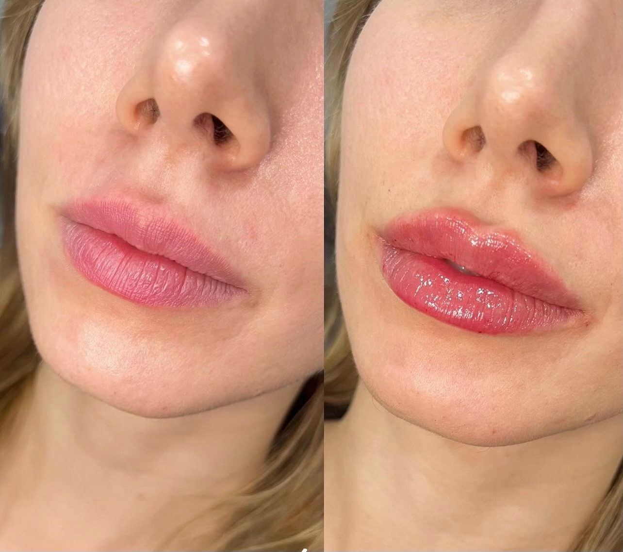 Cult Aesthetics Before and After Lips