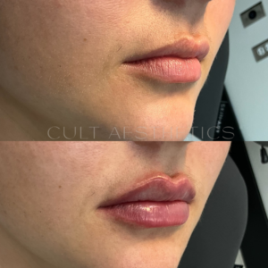 Russian Lips before and after
