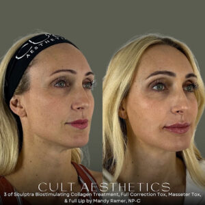 Sculptra Before and After: The Natural Volume Builder