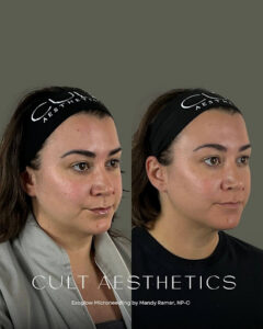 Exoglow Microneedling Before and After