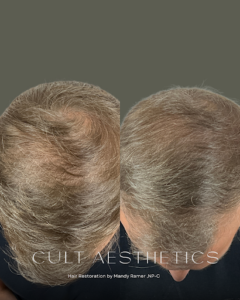 Hair Restoration before and after