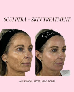 Sculptra: The Natural Foundation