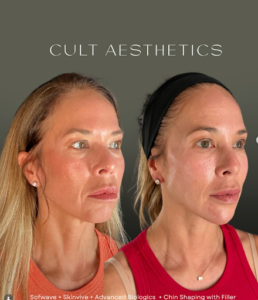 Sofwave: Next-Generation Collagen Tightening