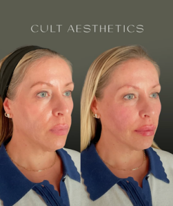 Bright Eyes Treatment + Skinvive