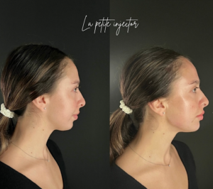 before and after facial balancing