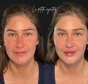 before and after Natural Lip Enhancement