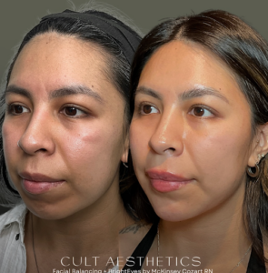 Signature Bright Eyes Treatment before/after